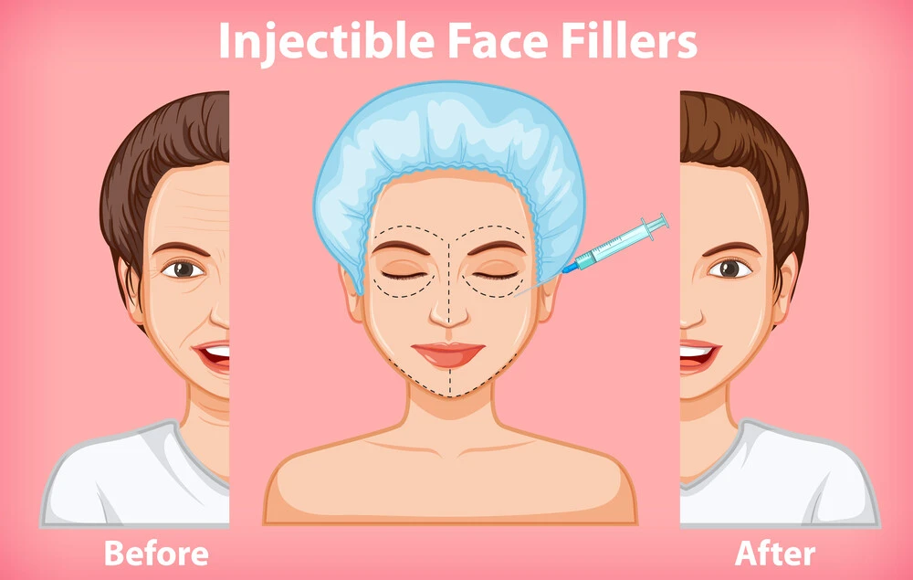 Can Dermal Fillers for Ozempic Face Really Help