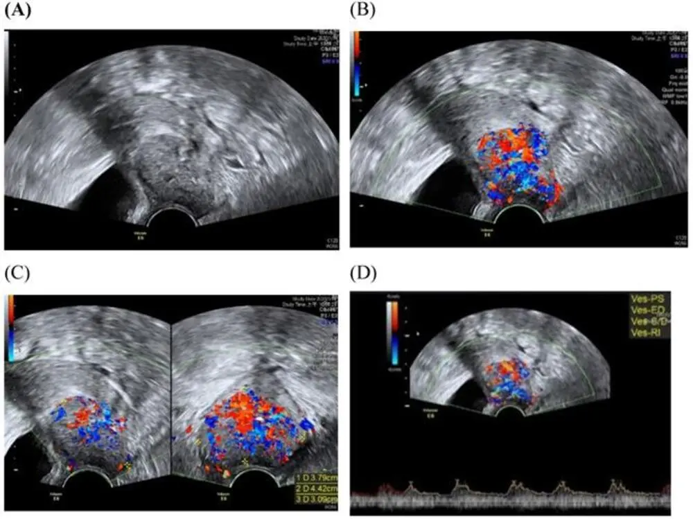 Can You See Cervical Cancer on Ultrasound
