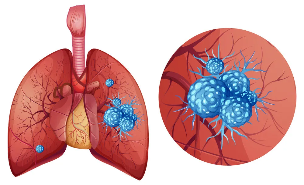 So What Is Sarcoma Lung Cancer, Anyway